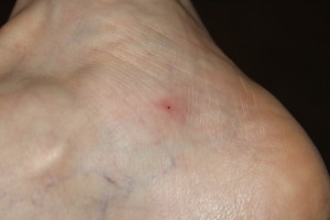 One of the bites on my ankle